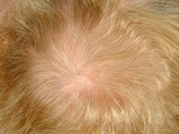 Частичную потерю волос на голове можно восполнить с помощью Latisse