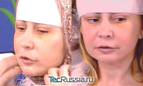 Ирина Агибалова – фото до и после пластических операций