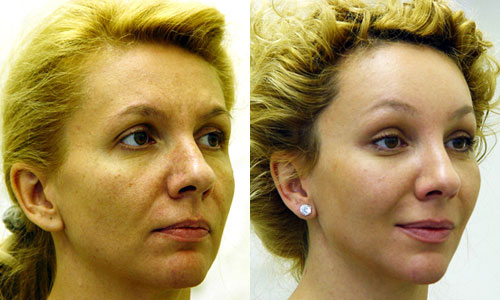 Подтяжка лица фото до и после