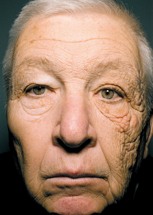 Результаты 28-летнего воздействия солнца на кожу лица