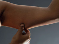 Брахиопластика – подтяжка кожи рук