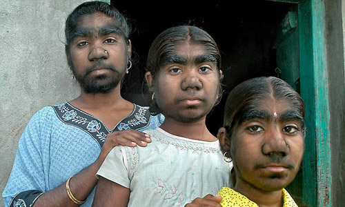 В российской клинике пластической хирургии вылечат индийских «сестер-оборотней»