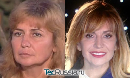 Ирина Агибалова до и после после пластики и ряда косметологических процедур