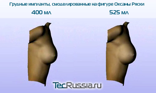 Оксана Ряска до и после увеличения груди