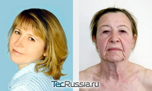 Елена Сидорук до и после заболевания Cutis laxa (Синдром «вялой кожи»)