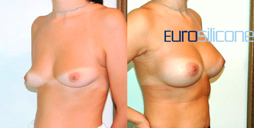 до и после увеличения груди, хирург М.В.Егорова