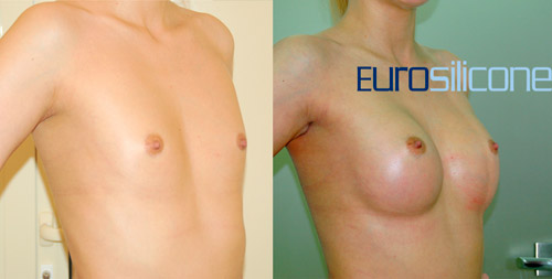 Пластика груди, импланты ЕвроСиликон