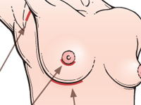 Виды операционного доступа при увеличении и подтяжке груди