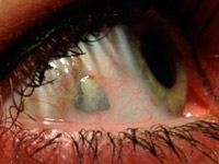 Имплантация ювелирных украшений в глаза может прийти на смену пирсингу