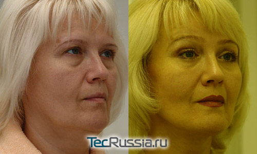 До и после подтяжки лица (хирург Татьяна Иванченкова)
