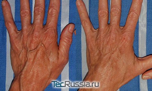 Фото до и после эндовенознаой лазерной облитерации (ЭВЛО) кистей рук