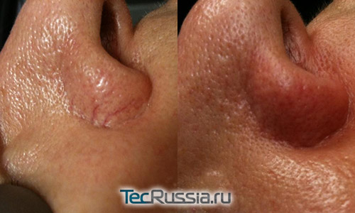 Лечение купероза – фото до и после