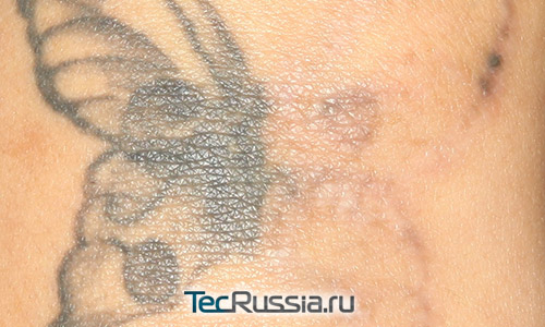 Фото татуировки, на правой части которой проведена процедура лазерного удаления