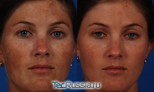 До и после лечения мелазмы на коже лица
