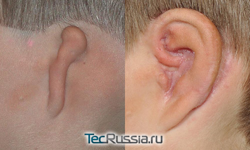 фото до и после реконструкции уха при микротии