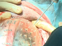 Девушке пересадили череп, напечатанный на 3D-принетре
