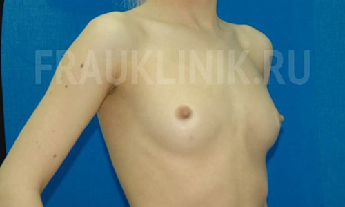Фото до эндоскопического увеличения груди
