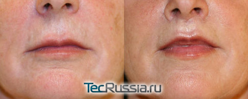 хирургическая подтяжка и увеличение губ – фото до и после