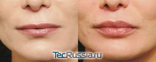фото до и после увеличения губ собственным жиром (липофилинг)