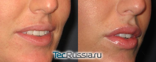 до и после контурной пластики губ