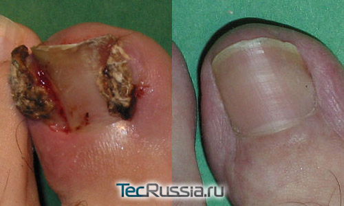фото до и после операции по лечению вросшего ногтя