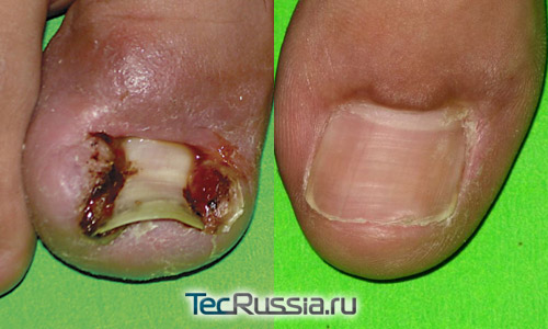 фото до и после хирургического лечения вросшего ногтя на ноге