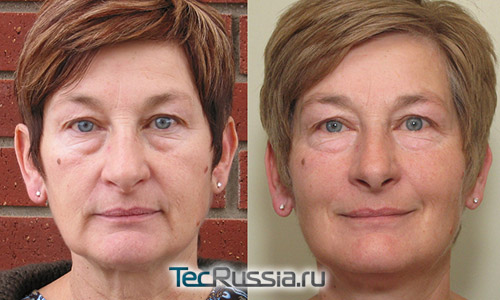 фото до и после микротоковой терапии лица