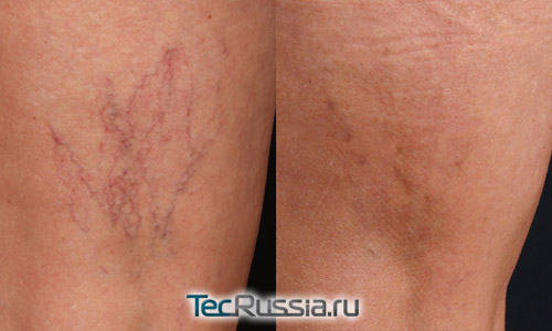фото до и после склератерапевтического лечения телеангиоэктазий на ноге