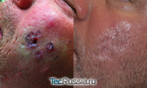 фото до и после хирургического иссечения угревых рубцов