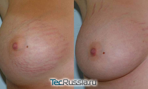 лазерное лечение стрий на груди, фото до и после
