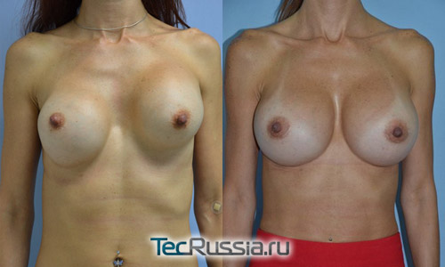 операция по замене грудных имплантов, фото до и после