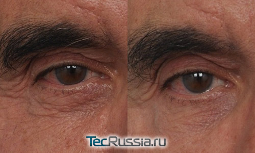 Удаление мешков под глазами без операции – фото до и после