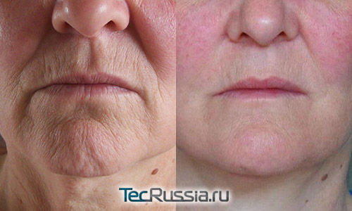 состояние морщин вокруг губ до и после подтяжки кожи лица