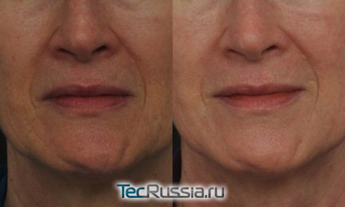 Удаление морщин вокруг рта лазером, фото до и после