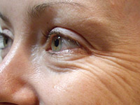 15 способов избавиться от морщин вокруг глаз