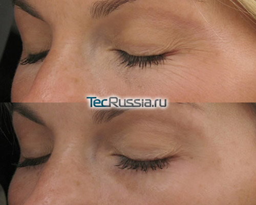 RF-лифтинг кожи вокруг глаз – фото до и после