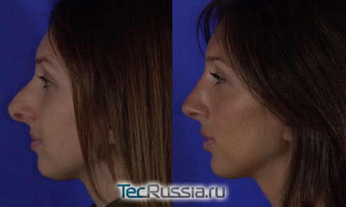 фото до и после повторной ринопластики, пациентка 1, вид в профиль