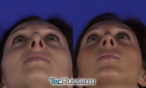 фото до и после повторной ринопластики, пациентка 1, вид снизу