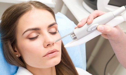 процедура лазерного удаления сосуда в области носа