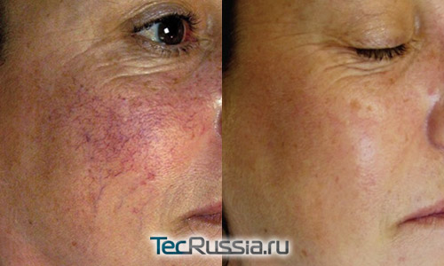 удаление сосудов на лице лазером – фото до и после