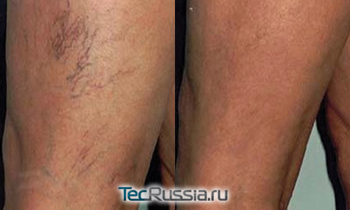 удаление расширенных вен на ногах – фото до и после