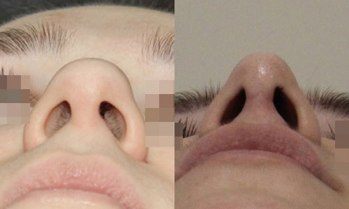 широкий кончик носа стал гораздо уже (хирург – В.С.Григорянц), вид снизу