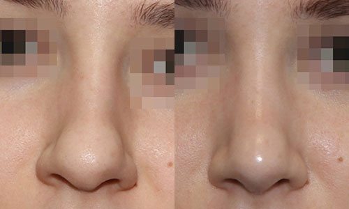 фото до и после пластики концичка носа (хирург – В.С.Григорянц), вид спереди