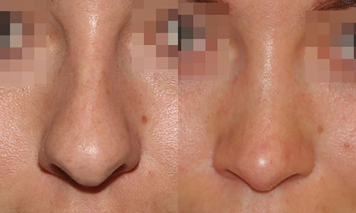 фото до и после пластики носа (хирург – В.С.Григорянц), профиль
