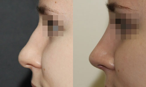 Спинка носа выровнена, горбинка удалена (хирург – В.С.Григорянц), профиль