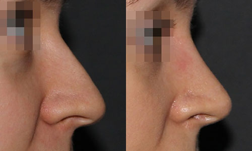 фото до и после пластики носа