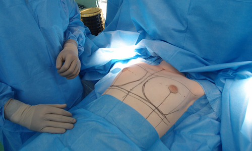 Пациентка перед операцией увеличения груди
