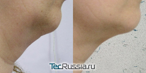 фото до и после уколов для похудения шеи
