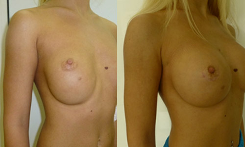 Фото до и после коррекции смещенного грудного импланта