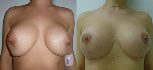 Подтяжка груди с заменой имплантов – фото до и после операции